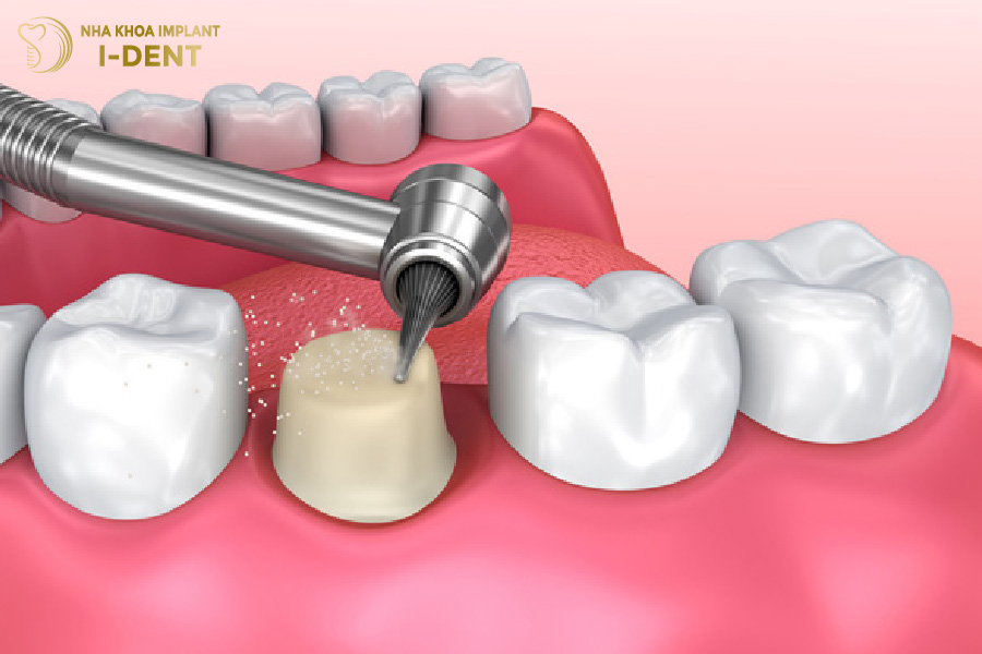Mài cùi răng sứ có ảnh hưởng gì không? Mài cùi răng sứ có ảnh hưởng gì không?
