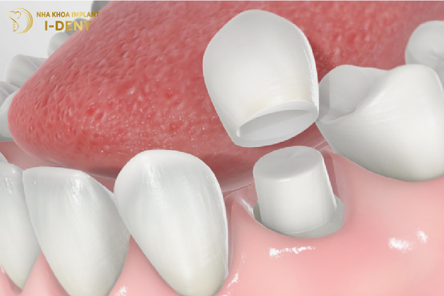 Mão răng sứ có thể bị chật theo thời gian Mão răng sứ có thể bị chật theo thời gian