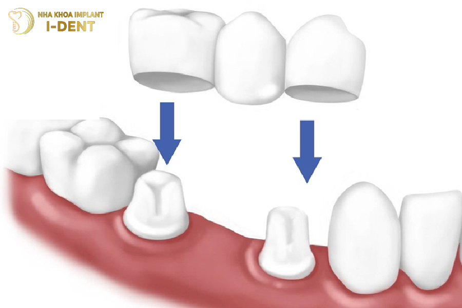 Kỹ thuật bắt cầu răng sứ Kỹ thuật bắt cầu răng sứ