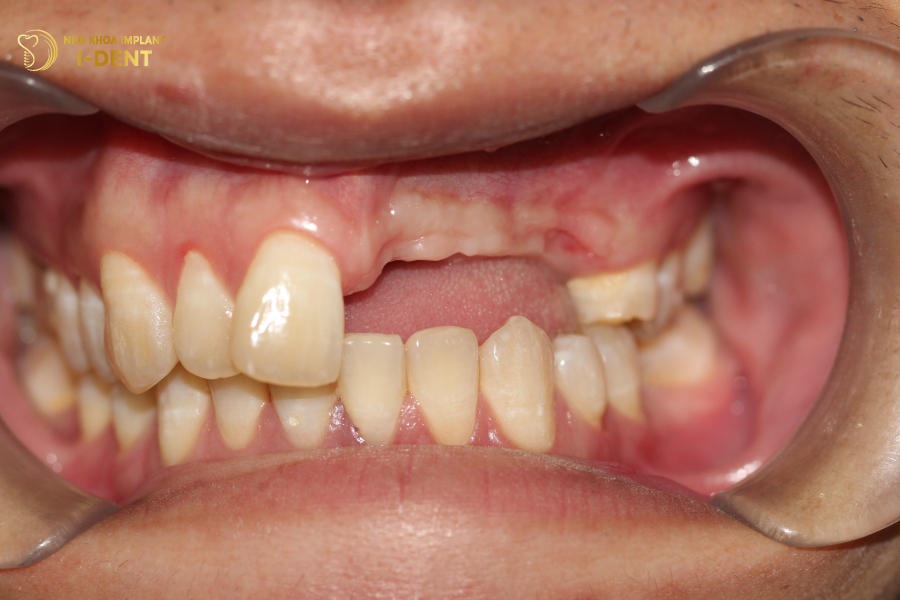 Mất 4 răng liên tiếp khiến các răng bên cạnh bị xô lệch, mọc trồi Mất 4 răng liên tiếp khiến các răng bên cạnh bị xô lệch, mọc trồi
