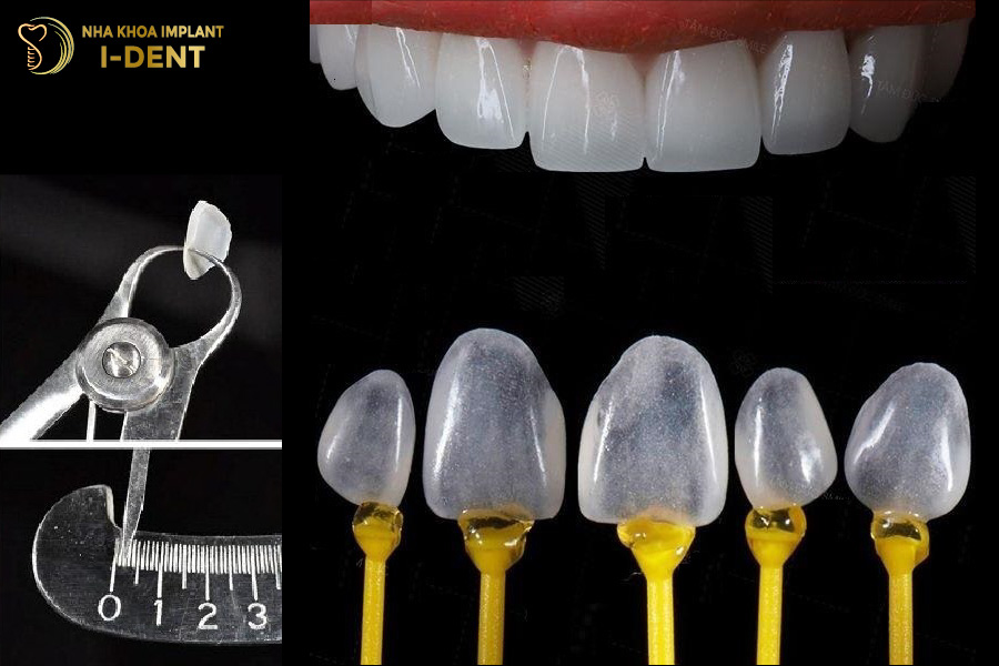 Mặt dán sứ Veneer Lingual/Palatal Mặt dán sứ Veneer Lingual/Palatal