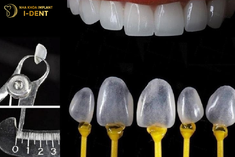 Mặt dán sứ Veneer Lisi Press Ultra Thin siêu mỏng như kính áp tròng Mặt dán sứ Veneer Lisi Press Ultra Thin siêu mỏng như kính áp tròng