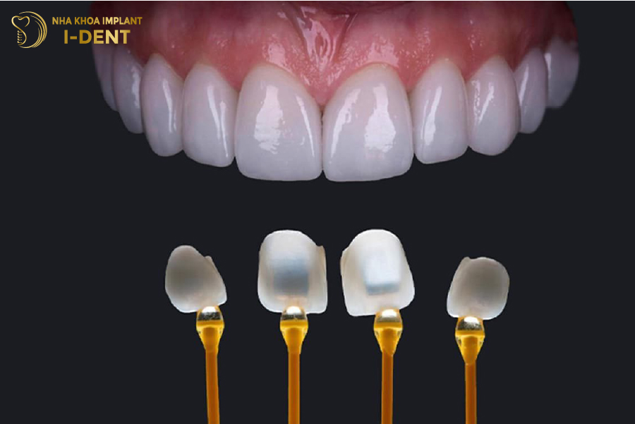 Mặt dán sứ vô cùng mỏng nhẹ và trắng bóng tự nhiên như răng thật Mặt dán sứ vô cùng mỏng nhẹ và trắng bóng tự nhiên như răng thật