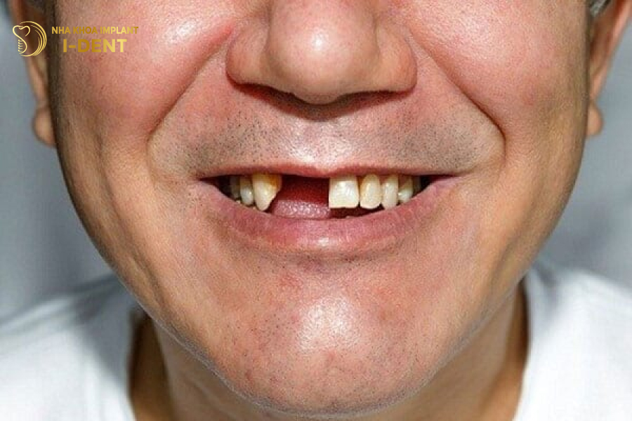 Nhổ răng bao lâu thì trồng lại được? Nhổ răng bao lâu thì trồng lại được