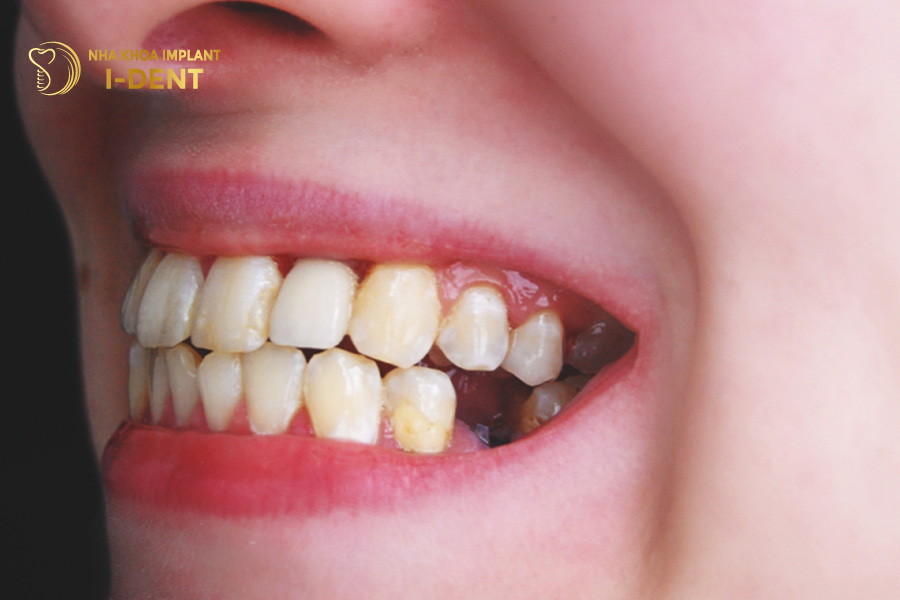 Mất răng là một trong những biến chứng nguy hiểm của áp xe chân răng