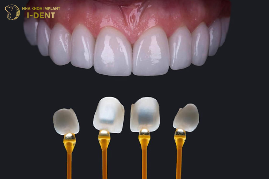 Mặt sứ Veneer Emax Mặt sứ Veneer Emax