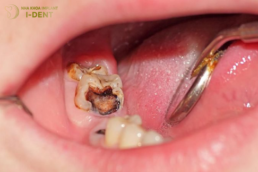 Mất thân răng còn chân vẫn có thể bị tiêu xương Mất thân răng còn chân vẫn có thể bị tiêu xương