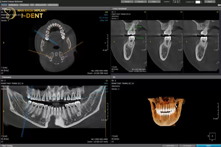Máy CT Cone Beam thể hiện rõ độ rộng của xương hàm Máy CT Cone Beam thể hiện rõ độ rộng của xương hàm