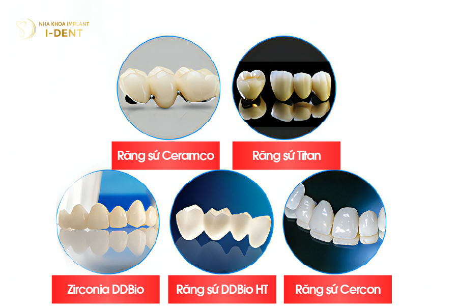 Một số dòng răng sứ tại nha khoa I-DENT Một số dòng răng sứ tại nha khoa I-DENT