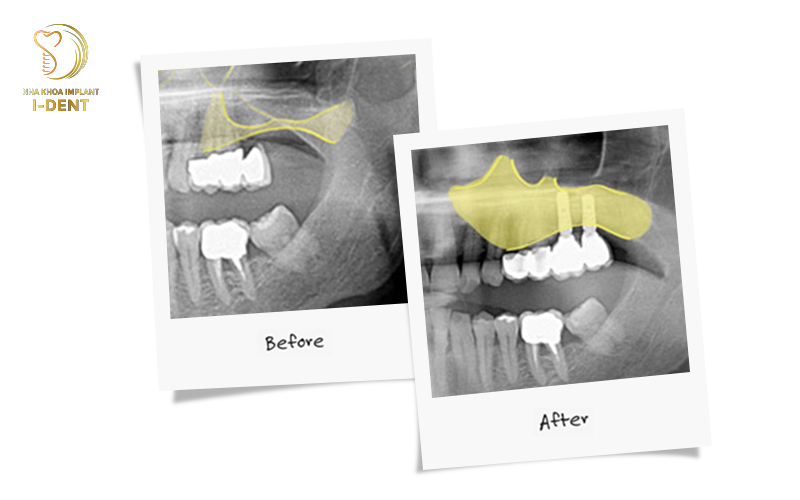 Nâng xoang hàm trong cấy ghép Implant Nâng xoang hàm trong cấy ghép Implant