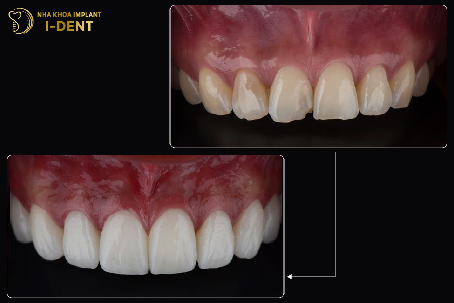 Nên bọc lại răng sứ mới khi mão sứ cũ đã bị nứt vỡ Nên bọc lại răng sứ mới khi mão sứ cũ đã bị nứt vỡ