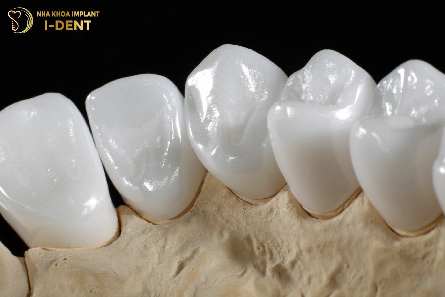 Nên thay răng sứ kim loại bằng răng toàn sứ để đảm bảo an toàn chân răng sứ bị hôi