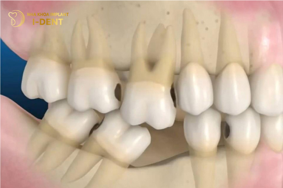 Mất răng khiến các răng kế cận bị xô lệch, lung lay Mất răng khiến các răng kế cận bị xô lệch, lung lay
