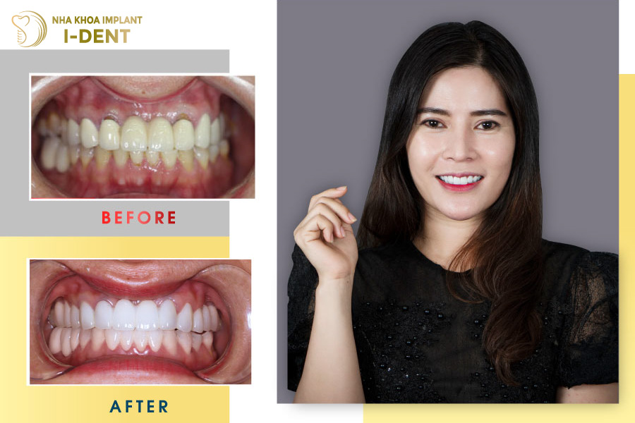 Nha khoa I-DENT bọc răng sứ theo tiêu chuẩn Pháp Nha khoa I-DENT bọc răng sứ theo tiêu chuẩn Pháp