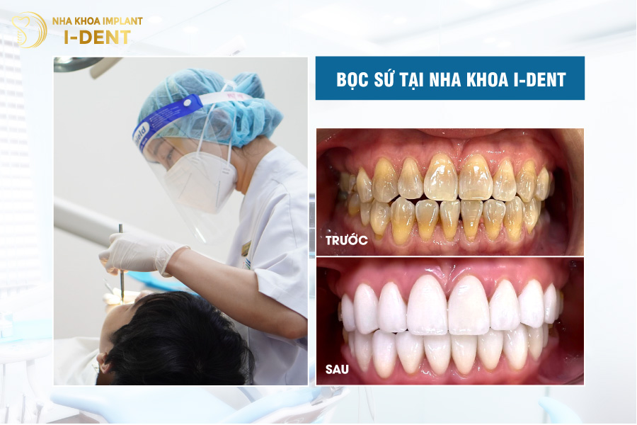 Nha khoa I-DENT chuyển giao công nghệ bọc sứ từ Pháp Nha khoa I-DENT chuyển giao công nghệ bọc sứ từ Pháp