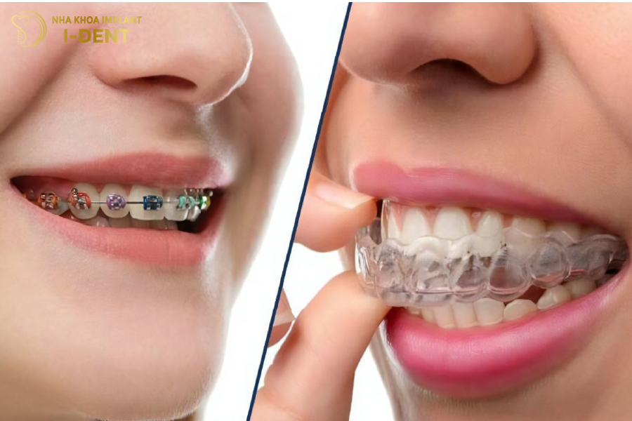 Nhiều loại hình niềng răng cho khách hàng lựa chọn Nhiều loại hình niềng răng cho khách hàng lựa chọn
