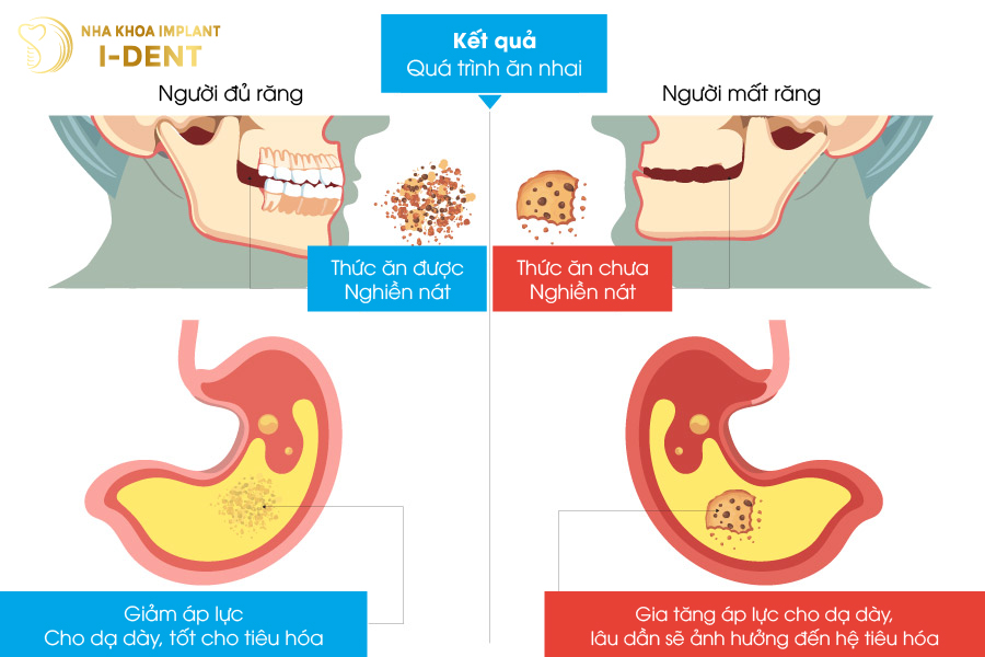 Ảnh hưởng đến quá trình ăn nhai nhổ răng không trồng lại có sao không