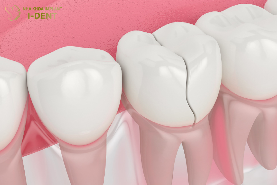 Những dấu hiệu nhận biết răng sứ hết hạn Những dấu hiệu nhận biết răng sứ hết hạn