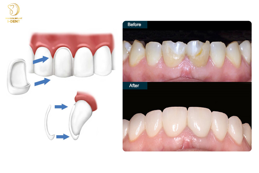 Tráng răng sứ áp dụng cho những trường hợp răng thưa, hở kẽ, ố vàng,... Tráng răng sứ áp dụng cho những trường hợp răng thưa, hở kẽ, ố vàng,...