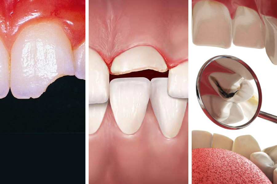 Những trường hợp nên trám răng Những trường hợp nên trám răng