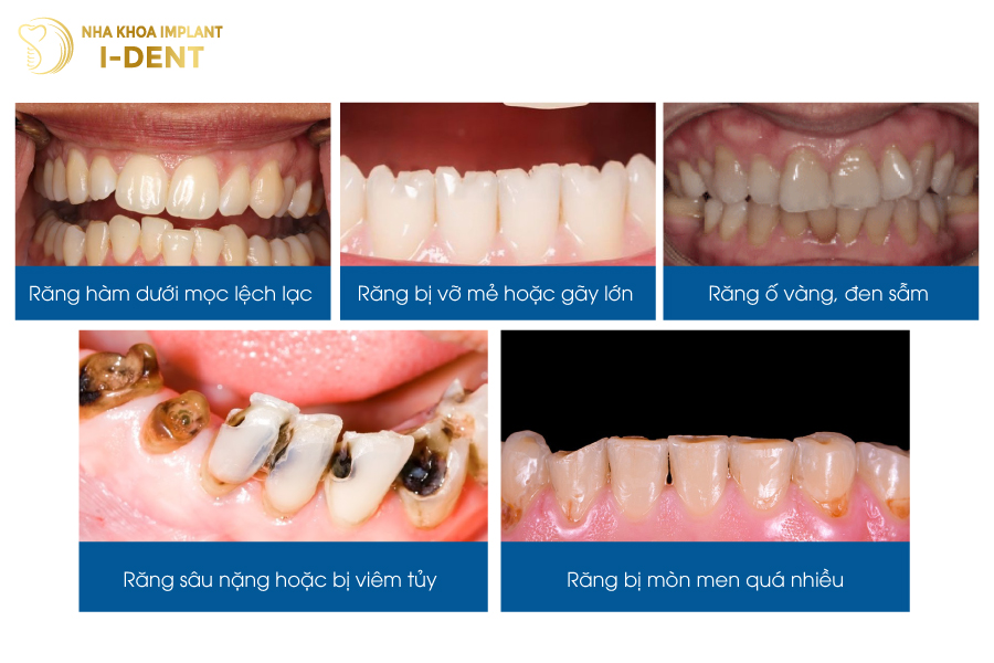 Những trường hợp nên bọc răng sứ hàm dưới Những trường hợp nên bọc răng sứ hàm dưới