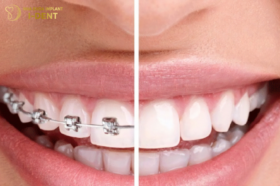 Nên niềng răng hay bọc sứ sẽ giúp cải thiện thẩm mỹ cho răng hiệu quả Nên niềng răng hay bọc sứ sẽ giúp cải thiện thẩm mỹ cho răng hiệu quả