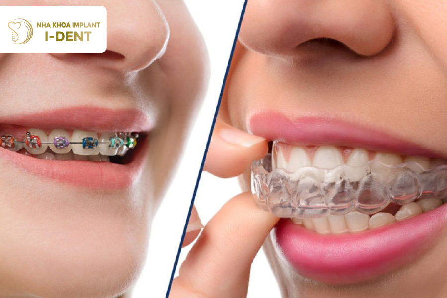 Niềng răng và bọc sứ sẽ phù hợp cho từng tình trạng răng khác nhau Niềng răng và bọc sứ sẽ phù hợp cho từng tình trạng răng khác nhau