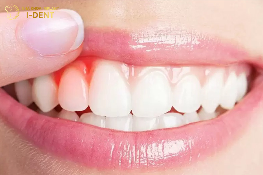 Nướu sưng đỏ, đau nhức do quá trình bọc sứ không đảm bảo Nướu sưng đỏ, đau nhức do quá trình bọc sứ không đảm bảo