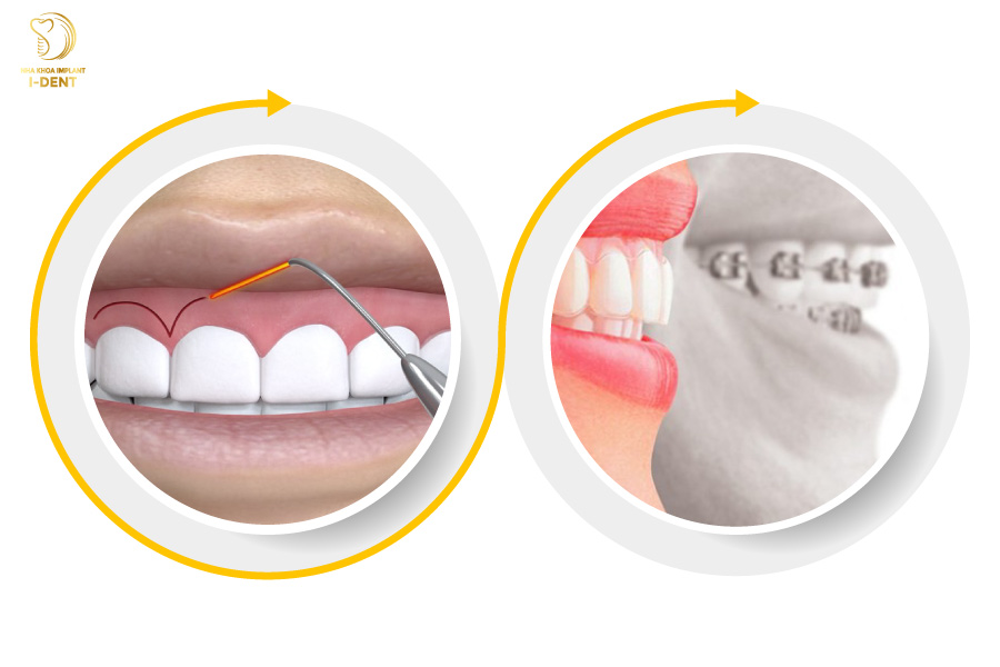 Phẫu thuật mài gồ xương ổ răng kết hợp với niềng răng Phẫu thuật mài gồ xương ổ răng kết hợp với niềng răng
