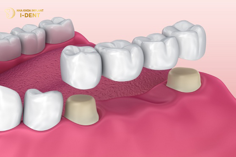 Phục hình 4 răng bằng phương pháp làm cầu răng sứ Phục hình 4 răng bằng phương pháp làm cầu răng sứ