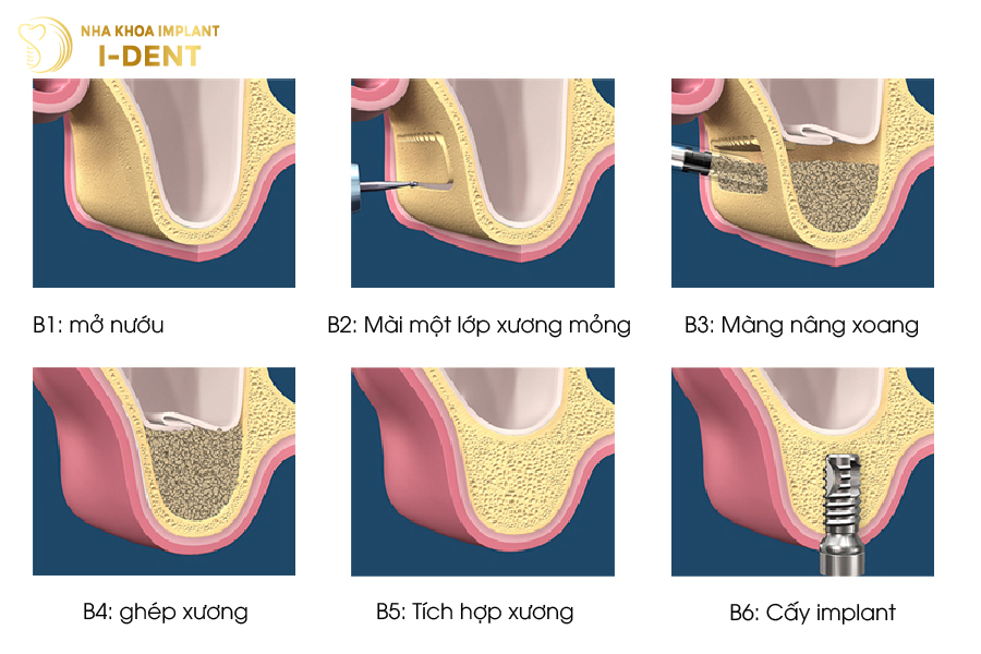 Quy trình nâng xoang hở Quy trình nâng xoang hở