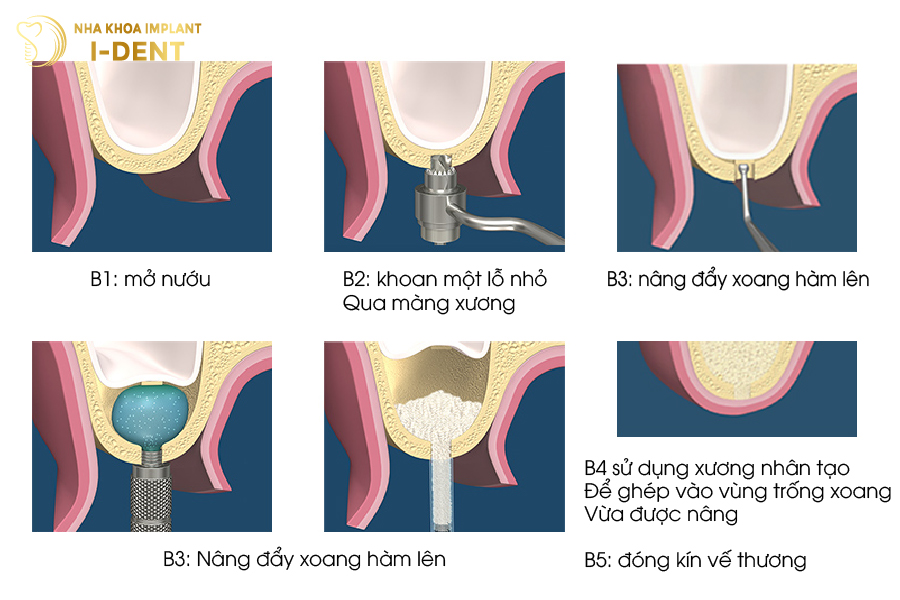 Quy trình nâng xoang kín Quy trình nâng xoang kín