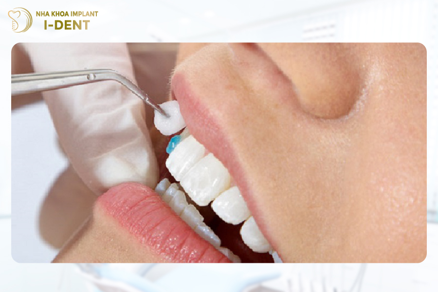 Quy trình tráng men răng khá đơn giản và không phải chăm sóc quá kỹ sau khi thực hiện Quy trình tráng men răng khá đơn giản và không phải chăm sóc quá kỹ sau khi thực hiện