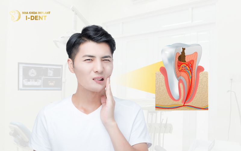 Răng bị sâu do các vi khuẩn có hại gây nên