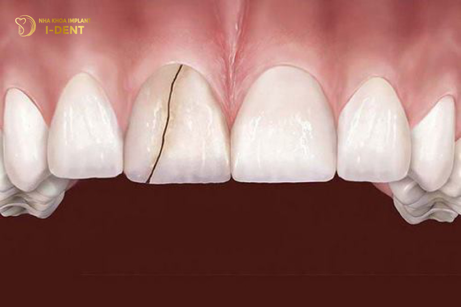 Răng sứ bị nứt, vỡ Răng sứ bị nứt, vỡ