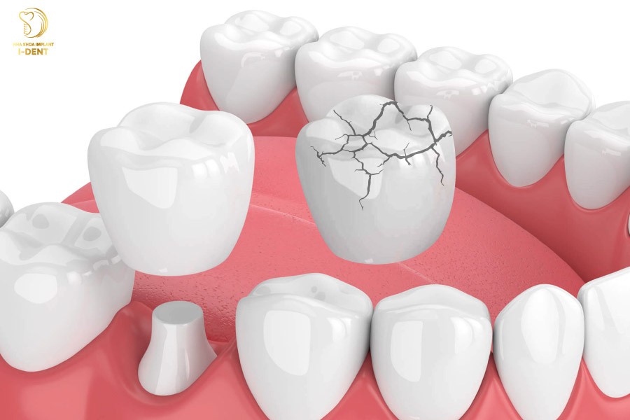 Răng sứ bị nứt, vỡ bọc răng sứ có ảnh hưởng gì không