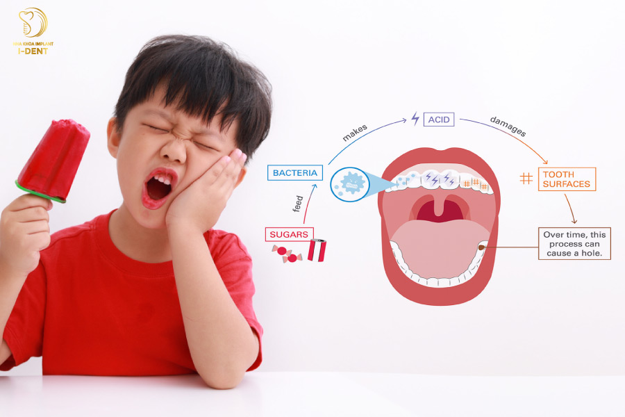 Trường hợp cần trám răng cho bé Trường hợp cần trám răng cho bé