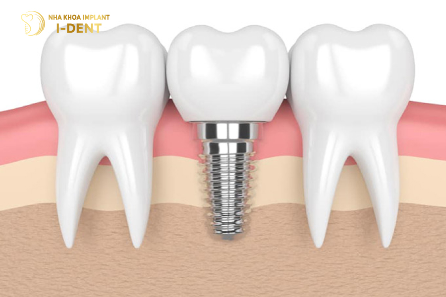 Phục hình răng sứ trên Implant Phục hình răng sứ trên Implant