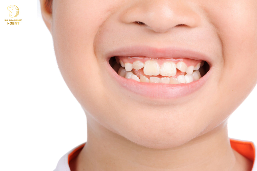 Răng lộn xộn có bọc sứ được không? Răng lộn xộn có bọc sứ được không