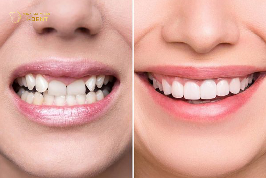 Răng móm nhẹ có thể được cải thiện bằng cách bọc sứ Răng móm nhẹ có thể được cải thiện bằng cách bọc sứ