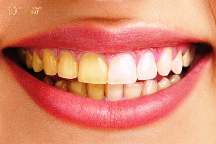 Răng sứ bị xuống màu Răng sứ bị xuống màu