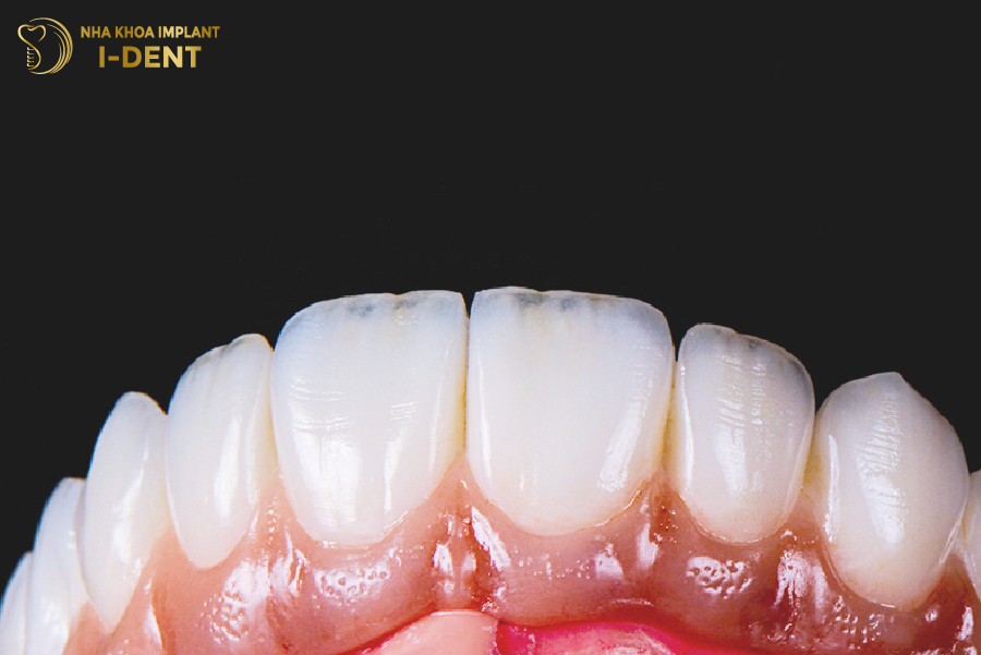 Răng sứ có hình dáng và màu sắc giống như răng thật