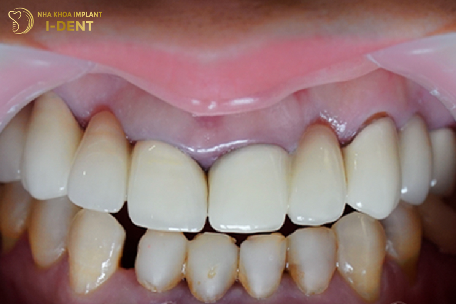 Răng sứ đổi màu, gây đen viền nướu do sử dụng phải vật liệu kém chất lượng Răng sứ đổi màu, gây đen viền nướu do sử dụng phải vật liệu kém chất lượng