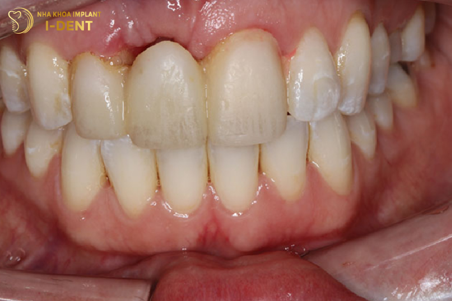 Răng sứ kém thẩm mỹ do thực hiện tại nha khoa không uy tín thay răng sứ
