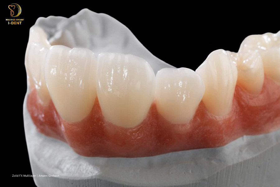 Răng sứ không kim loại Zolid Răng sứ không kim loại Zolid