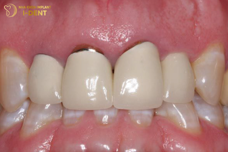 Răng sứ kim loại bị oxy hóa, gây đen viền nướu nên thay lại sứ mới bọc răng sứ lần 2