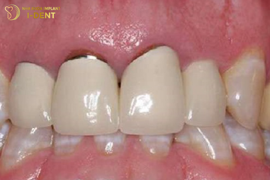 Hở chân răng sứ gây mất thẩm mỹ nụ cười Hở chân răng sứ gây mất thẩm mỹ nụ cười