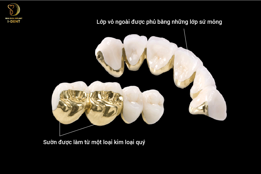 Răng sứ kim loại quý Răng sứ kim loại quý