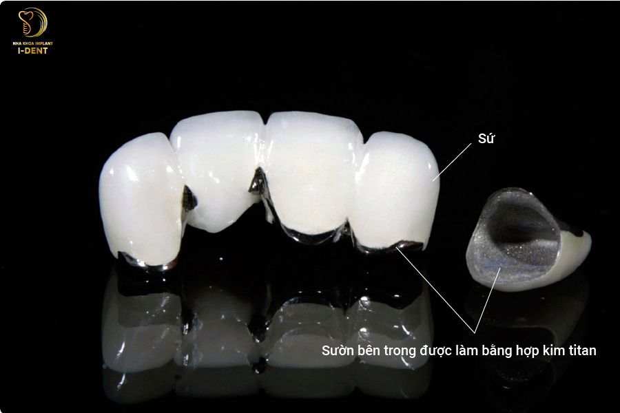 Răng sứ kim loại titan Răng sứ kim loại titan