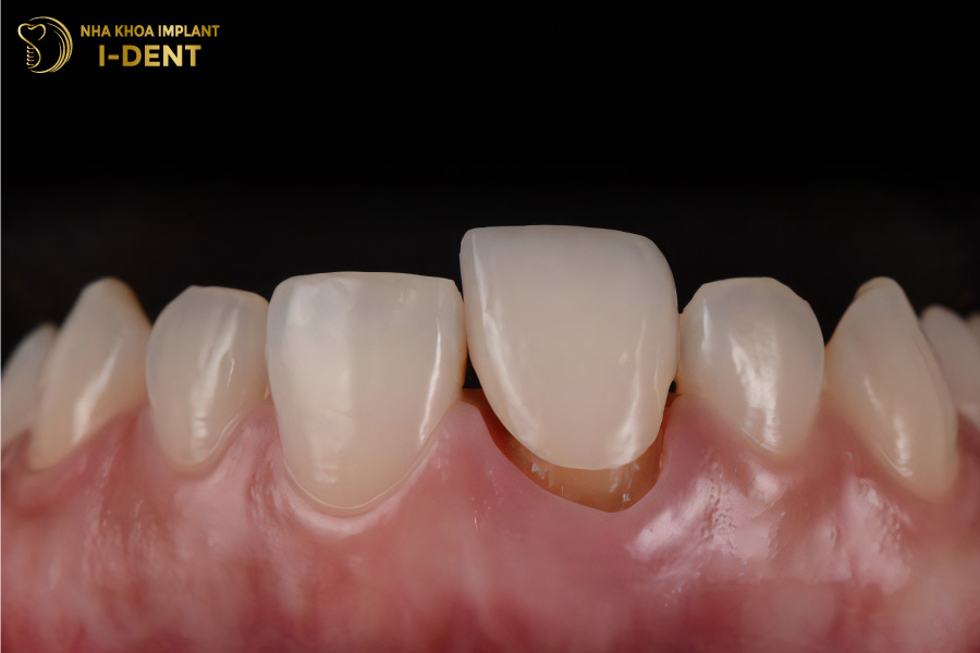 Răng sứ bị lung lay làm răng sứ có hại không